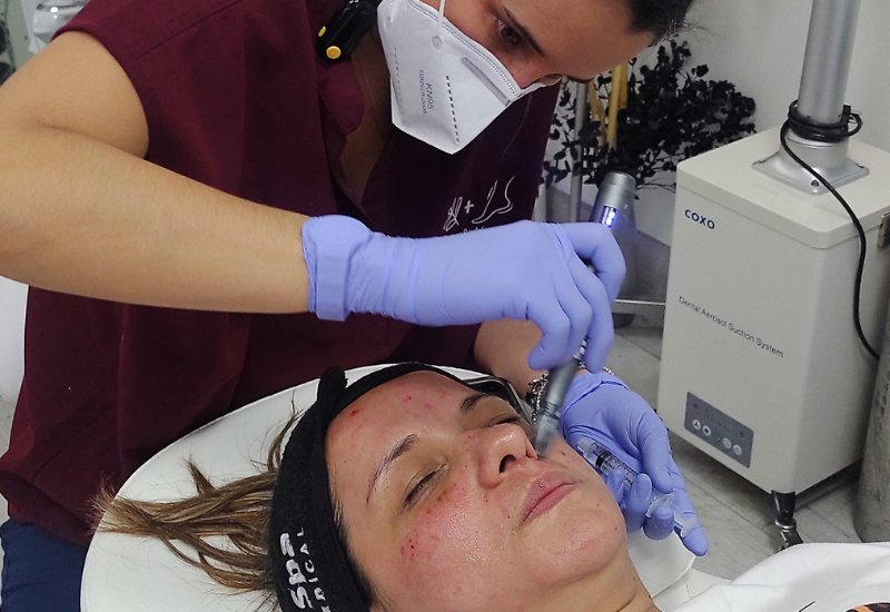 Dermapen en San José Costa Rica-1