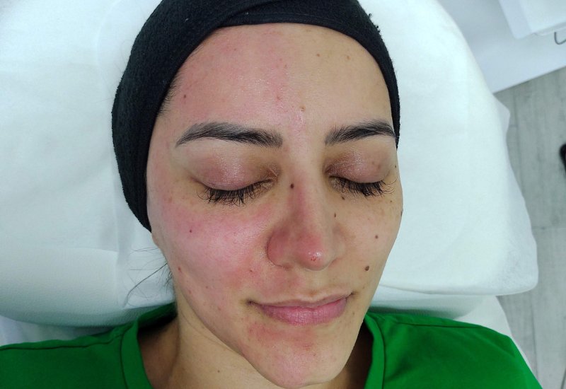 Dermapen en San José Costa Rica-4