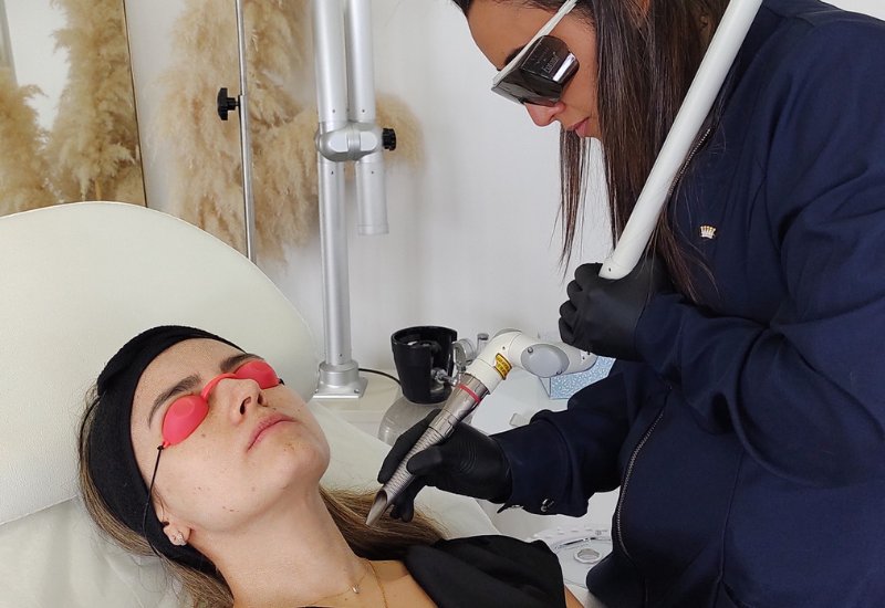 Peeling Facial en San José Costa Rica-3