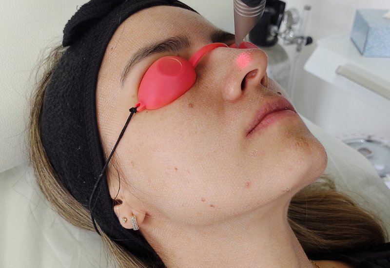 Peeling Facial en San José Costa Rica-4