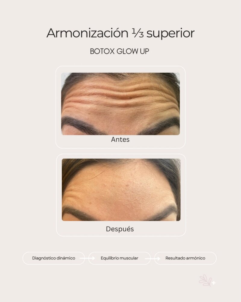 arrugas-frente-spa-medical arrugas-frente-spa-medical